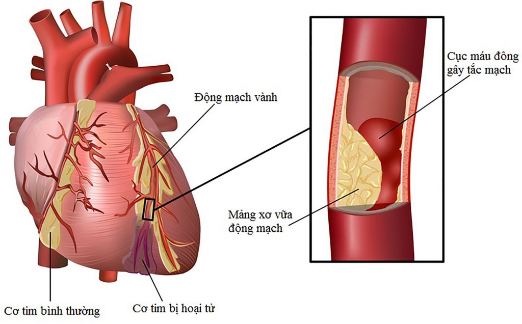Bệnh mỡ máu tiềm ẩn nguy cơ chết người