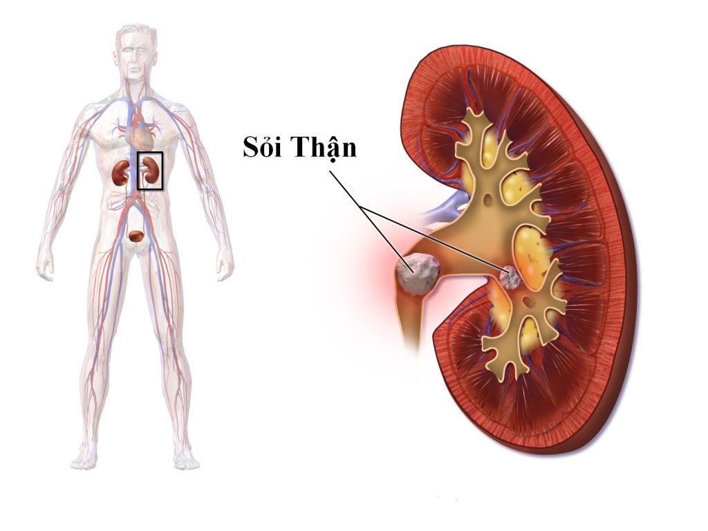 Những điều cần biết về bệnh sỏi thận mọi người cần lưu ý