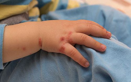 Phòng bệnh tay chân miệng cho trẻ Phòng bệnh tay chân miệng cho trẻ