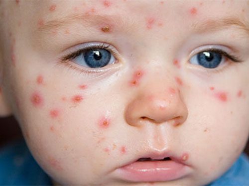 Hà Nội giảng viên Y học cổ truyền bật mí một số bài thuốc điều trị bệnh thủy đậu