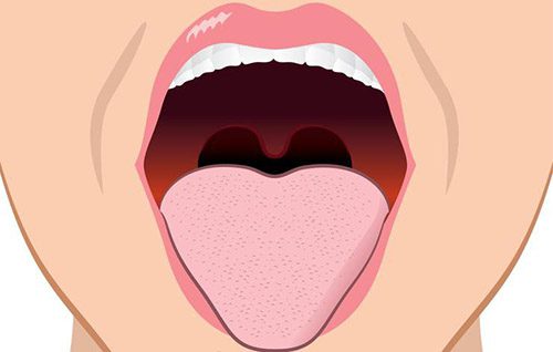 Biến chứng của viêm amidan nguy hiểm như thế nào tới sức khỏe?