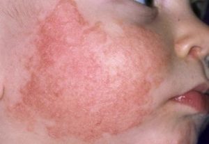 Bệnh chàm ở trẻ sơ sinh