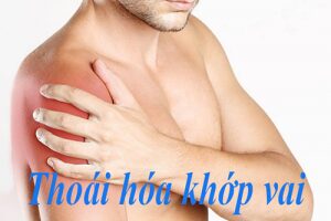 Để tránh khỏi biến chứng của thoái hóa khớp vai cần điều trị đúng cách