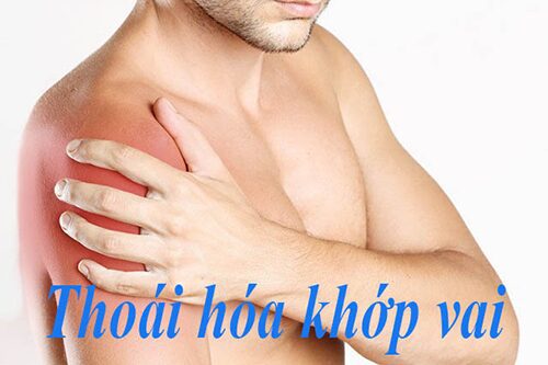 Để tránh khỏi biến chứng của thoái hóa khớp vai cần điều trị đúng cách