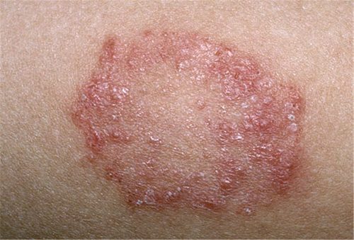 Tổng quan về bệnh hắc lào gây khó chịu cho người bệnh