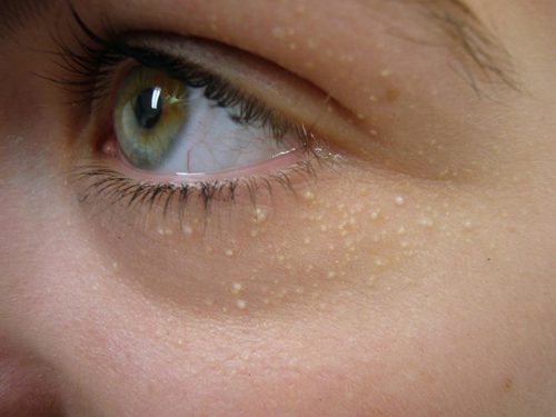 Mụn đầu trắng tuy không ảnh hưởng tới sức khỏe nhưng lại làm mất thẩm mỹ