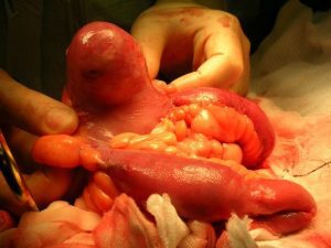 Cách nhận biết bệnh túi thừa Meckel