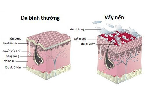 Cùng chuyên gia Điều dưỡng Hà Nội tìm hiểu bệnh vẩy nến