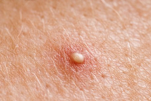 Mụn đầu trắng là một trong những vấn đề về da liễu