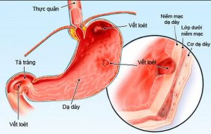 Ăn ít thực phẩm chiên rán