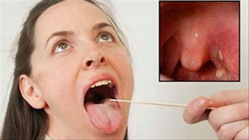 Cách điều trị bệnh viêm họng hiệu quả