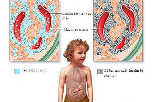 Điều trị bệnh tiểu đường type 1 không dùng thuốc như thế nào?