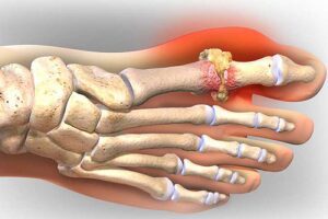 Nhiều người lầm tưởng bệnh gout với những vấn đề thường gặp
