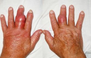 Dùng những bài thuốc dân gian và kết hợp các phương điều trị bệnh gout