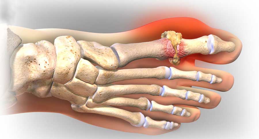Bệnh gút gây nguy hiểm cho cơ thể