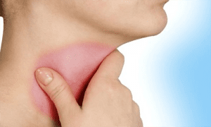 Nguyên nhân của bệnh viêm họng và hướng điều trị bệnh như thế nào?