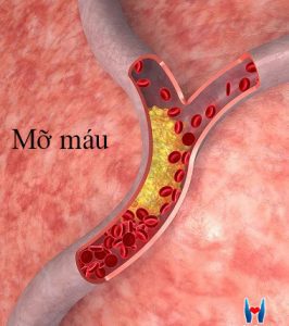 Nguyên nhân gây ra bệnh mỡ máu