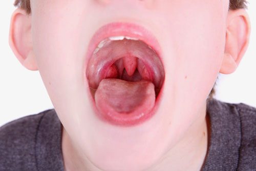 Nguyên nhân và triệu chứng bệnh viêm họng cấp
