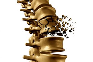 Những bệnh nhân loãng xương nên ăn những thực phẩm nào?