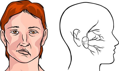 Những dấu hiệu khi bị liệt dây thần kinh ngoại biên số 7 là gì ?