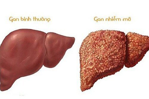 Những điều nên và không nên ăn gì để bệnh gan nhiễm mỡ mau khỏi là gì?