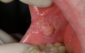 Những dấu hiệu nhận biết bệnh ung thư