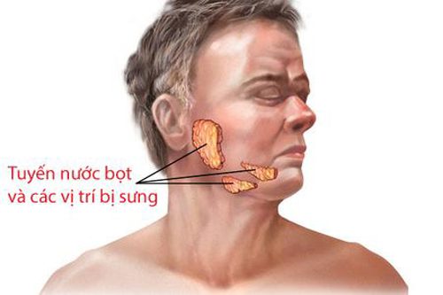 Phương pháp điều trị viêm tuyến nước bọt bằng thuốc hiệu quả