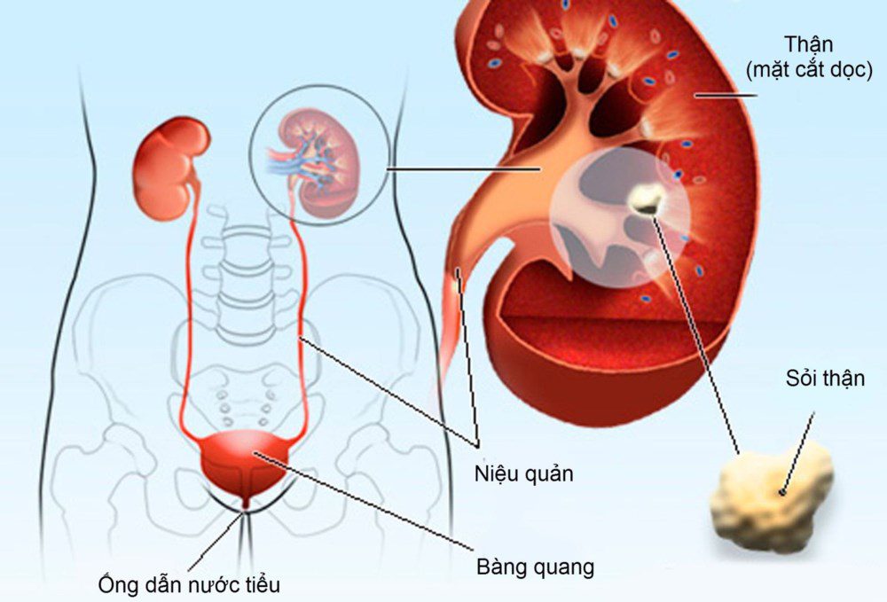 Những điều cần biết về bệnh sỏi thận mọi người cần lưu ý