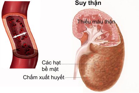 suy-than