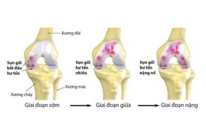 Tình trạng bệnh thoái hóa khớp gối hiện nay như thế nào?