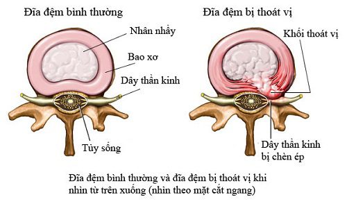 Lao động nặng là một trong những nguyên nhân chính gây thoát vị đĩa đệm cột sống thắt lưng