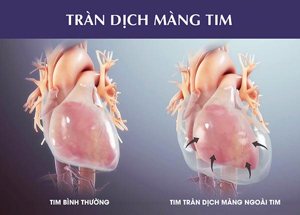 tran dich mang ngoai tim 1 5