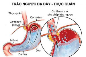 Hà Nội Dược sĩ hướng dẫn cách nhận biết biểu hiện và cách cải thiện trào ngược dạ dày