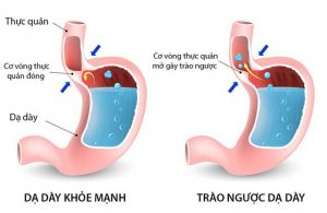 Khi trào ngược dạ dày - thực quản những cơn đau gây nên những khó chịu ảnh hưởng đến công việc