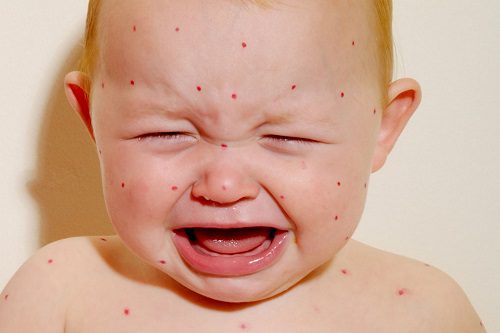 Triệu chứng bệnh sởi ở trẻ nhỏ