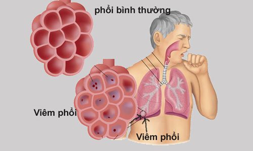 Phổi bình thường và phổi khi bị viêm untitled 1