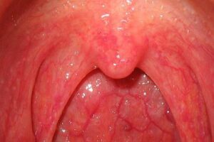 Viêm họng xung huyết và những điều cần biết về bệnh 