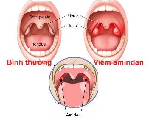 Khi điều trị viêm họng có nên cắt amidan hay không?