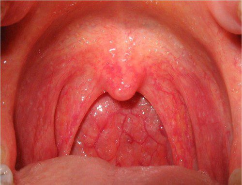 Viêm họng cấp ở trẻ em Viêm họng cấp ở trẻ em