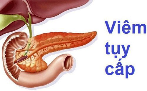 Viêm tụy cấp là gì?