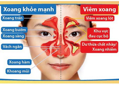 viem xoang mui va nhung bien chung nguy hiem 1 1