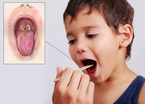 chan doan benh bach hau 2