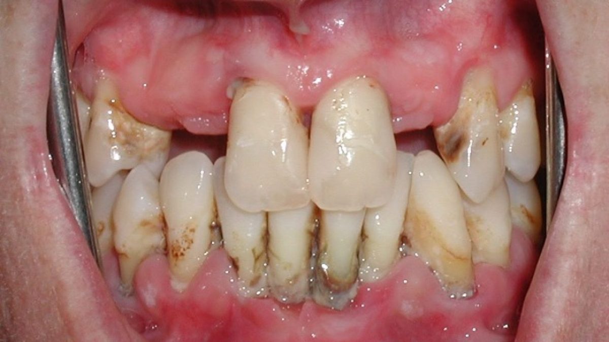 viem nha chu co the cay ghep implant duoc khong 2 1280x720 1 1200x675 1