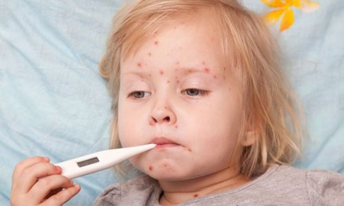 Sốt phát ban thường gặp ở trẻ em từ 6 - 36 tháng tuổi