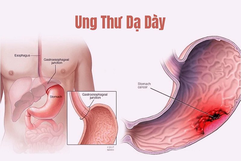 20210910 ung thu da day