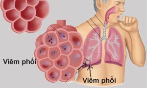 CC3B9ng chuyC3AAn gia tC3ACm hiE1BB83u bE1BB87nh viC3AAm phE1BB95i cC3B3 thE1BB83 gC3A2y tE1BBAD vong