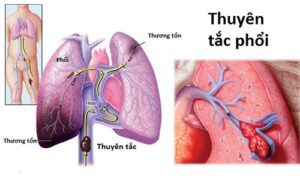 ChuyC3AAn gia C490iE1BB81u dC6B0E1BBA1ng cE1BAA3nh bC3A1o nhE1BBAFng dE1BAA5u hiE1BB87u thuyC3AAn tE1BAAFc mE1BAA1ch phE1BB95i 2
