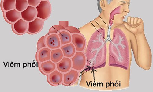 Cùng chuyên gia tìm hiểu bệnh viêm phổi có thể gây tử vong
