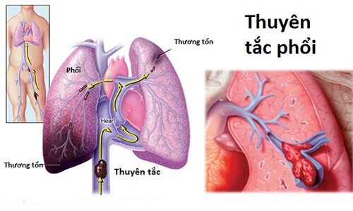 Chuyên gia Điều dưỡng cảnh báo những dấu hiệu thuyên tắc mạch phổi