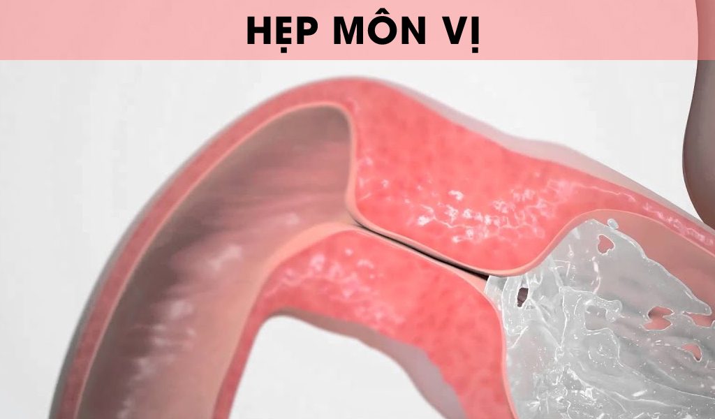 hep mon vi 1